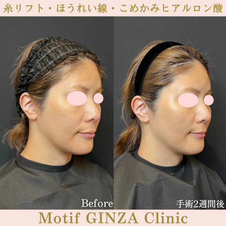 糸リフト（スレッドリフト） | 美容外科、婦人科形成の東京の